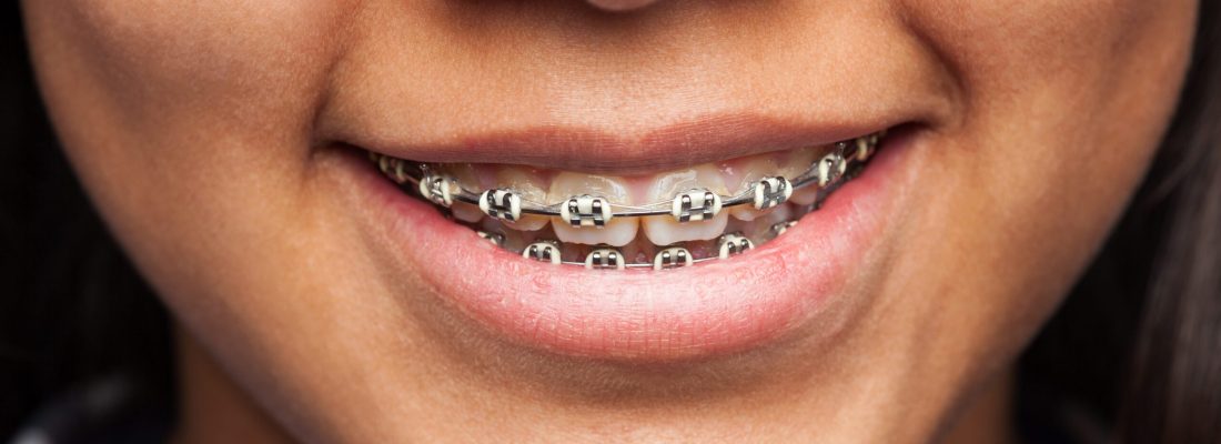 latin girl's mouth with brackets