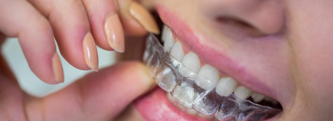 Close-up of woman wearing orthodontic silicone invisible braces